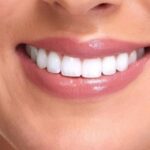 مراقبت بعد از بلیچینگ دندان