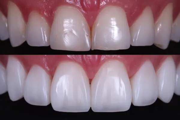 بهترین نوع ونیر کامپوزیت