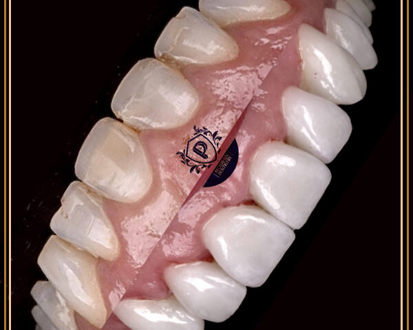 ترمیم دندان با درمان کامپوزیت